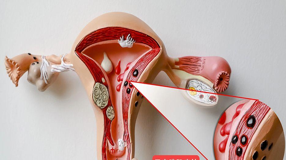 子宫腺肌症.webp (3).jpg