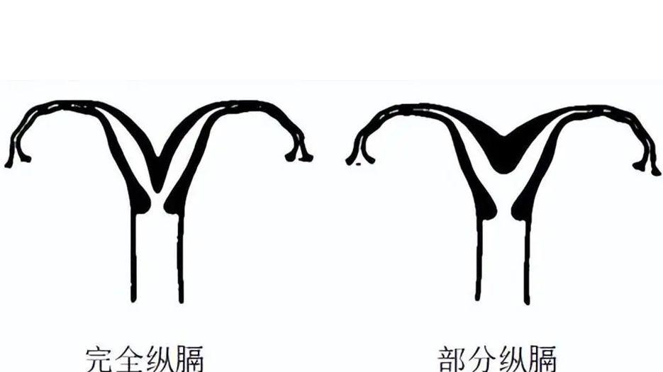 纵隔子宫.webp (1).jpg