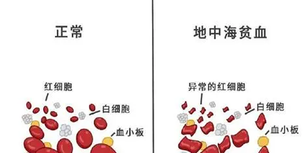 夫妻都有地中海贫血能做第三代试管婴儿吗-当然可以！