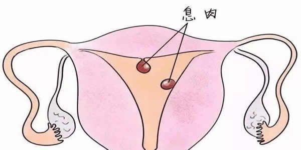 女性子宫内膜息肉可以做试管婴儿吗
