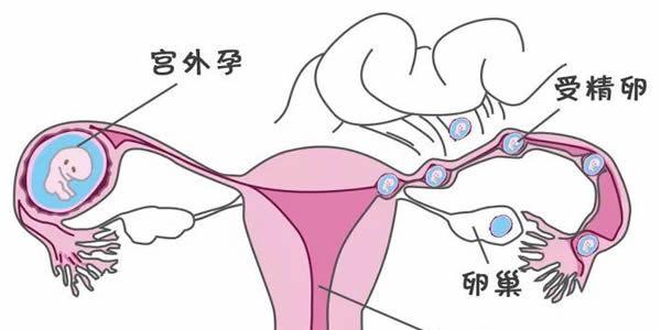 什么情况下做试管婴儿会发生宫外孕-生殖科普