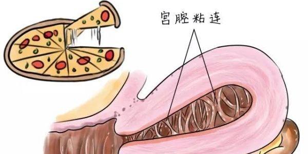 宫腔粘连对试管婴儿成功率有影响吗
