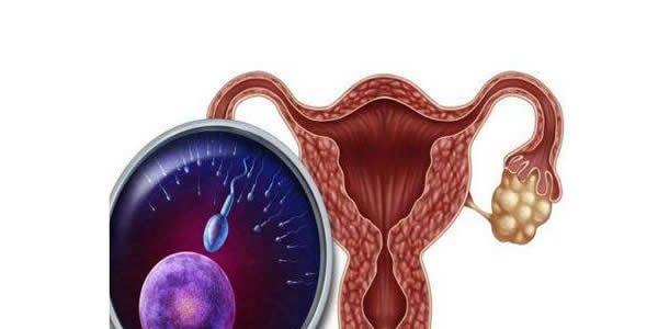 多囊卵巢综合症适合拮抗剂促排方案