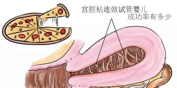 宫腔粘连做试管婴儿成功率有多少