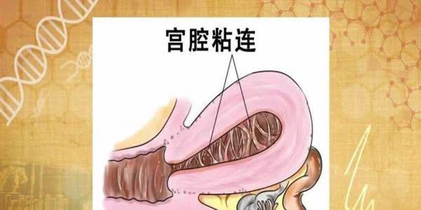 宫腔粘连做试管婴儿成功率有多少