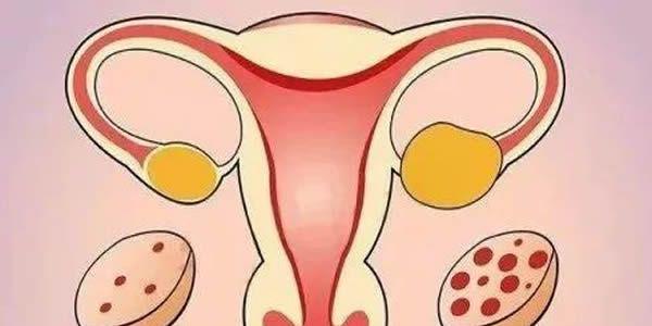 多囊卵巢综合症做试管婴儿一般定什么方案好