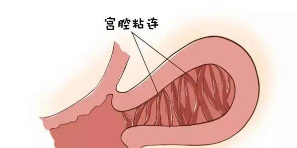 宫腔粘连可以做试管婴儿吗