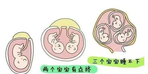 多胎妊娠