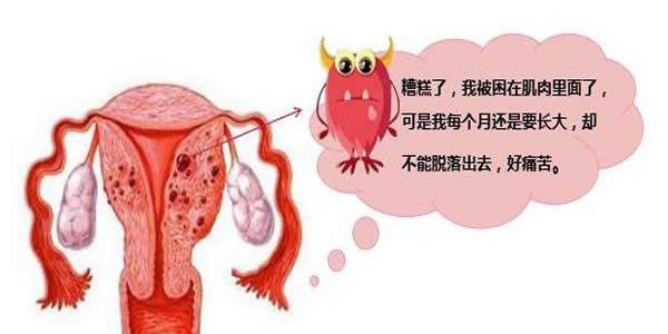 什么是子宫腺肌症