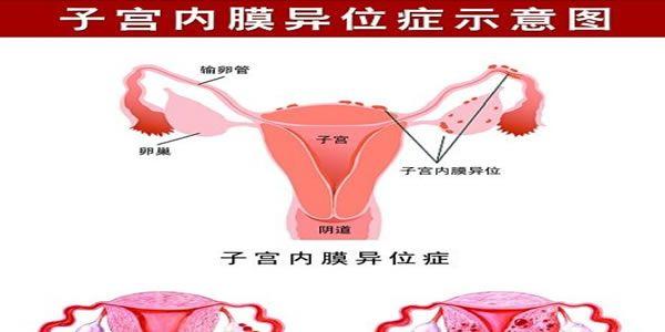 卵巢粘连是妇科疾病的一种，这种情况可以做试管婴儿吗