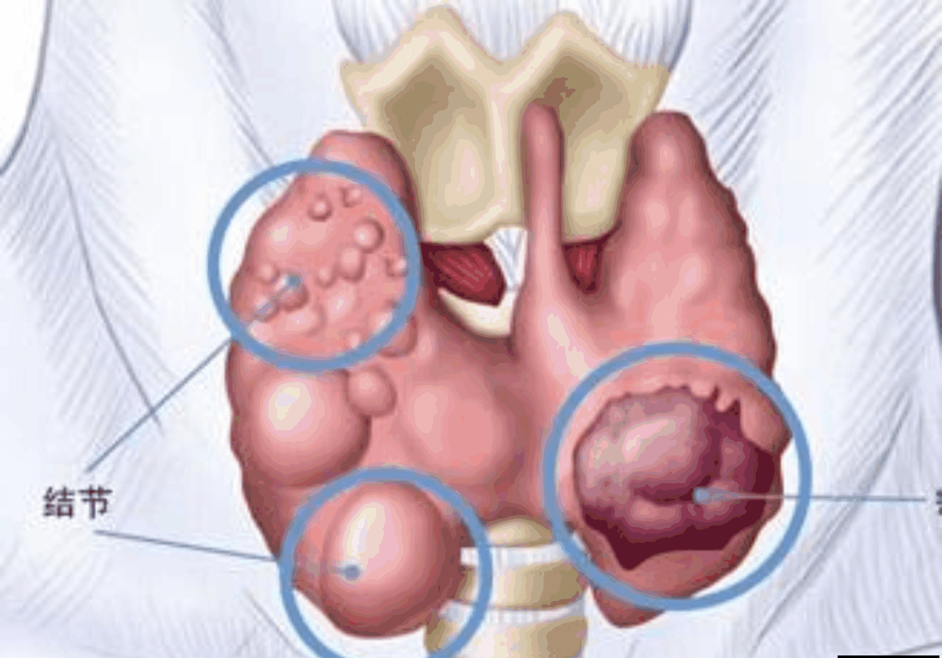 甲状腺结节伴钙化