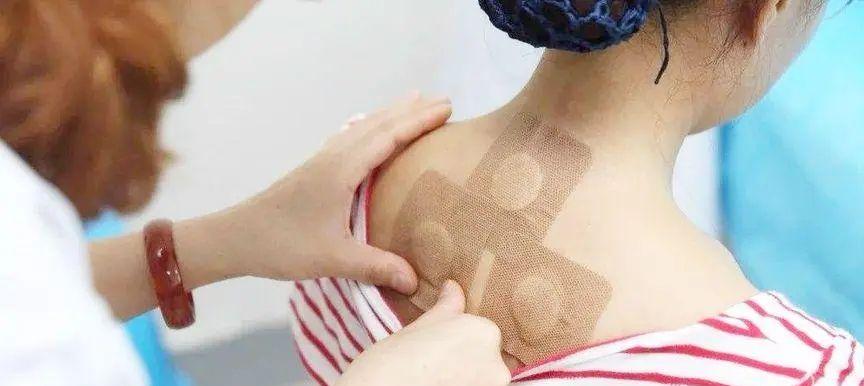 女人贴三伏贴