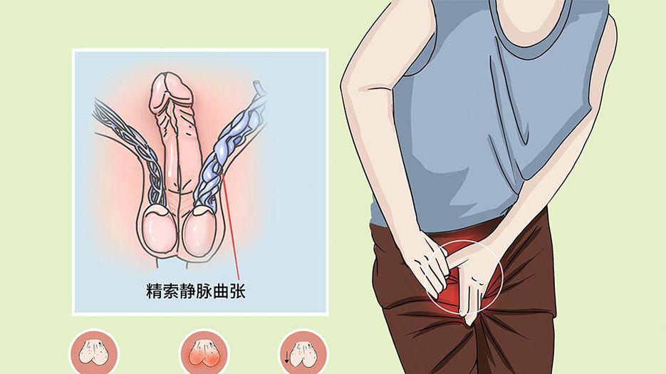 精索静脉曲张.jpg