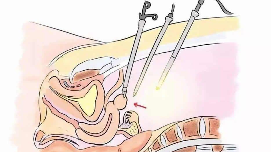 腹镜手术1.jpg