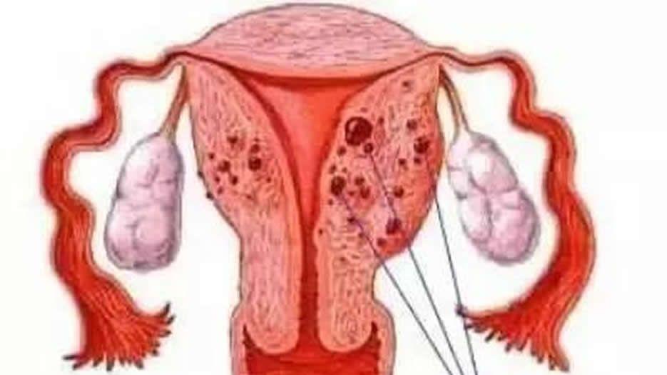 子宫腺肌症.jpg