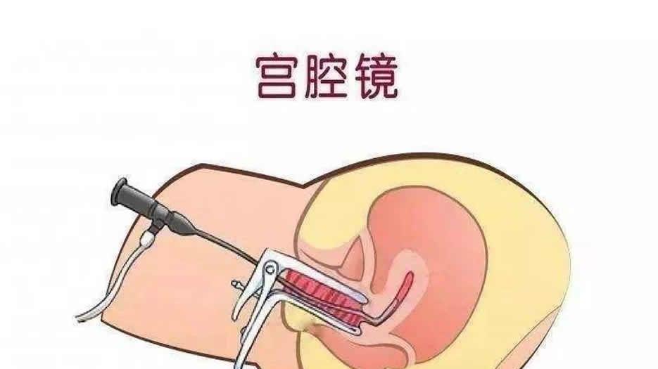 宫腔镜检查4.jpg