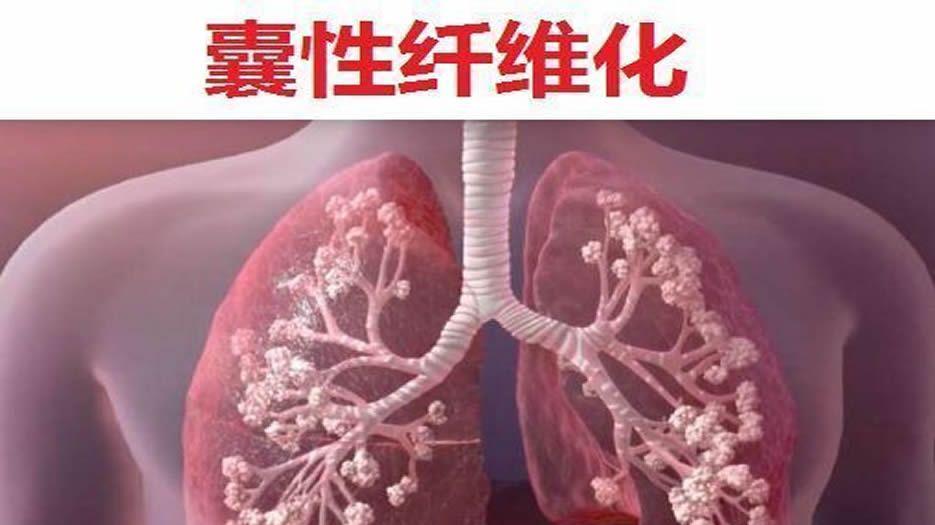 囊性纤维化1.jpg