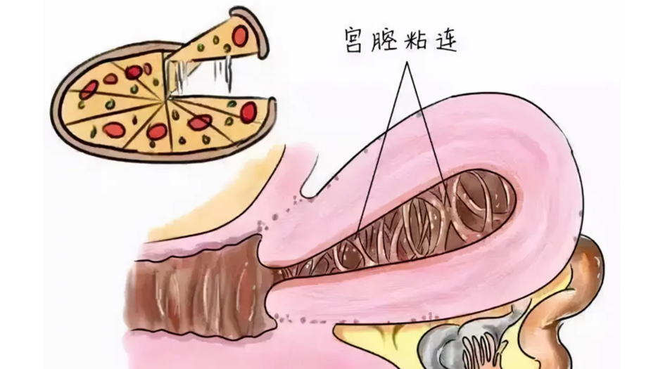 宫腔粘连.png