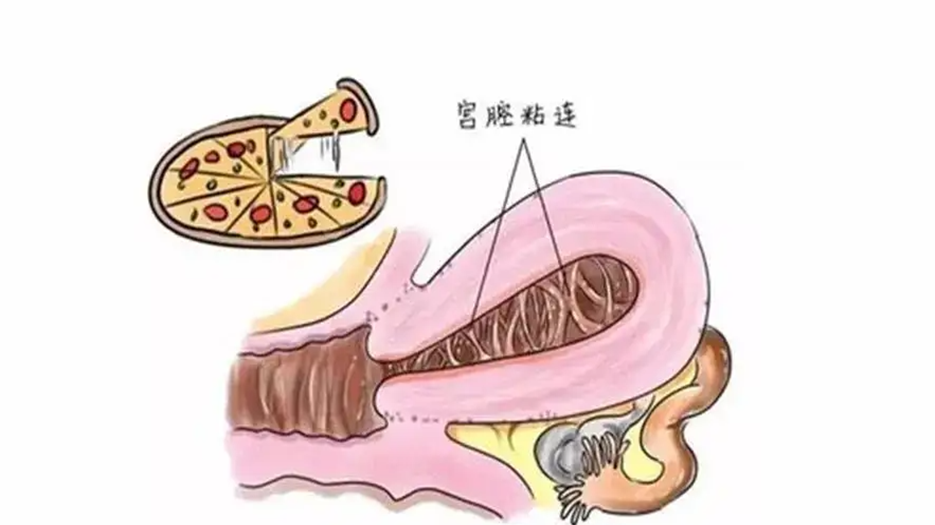 宫腔粘连八分.png