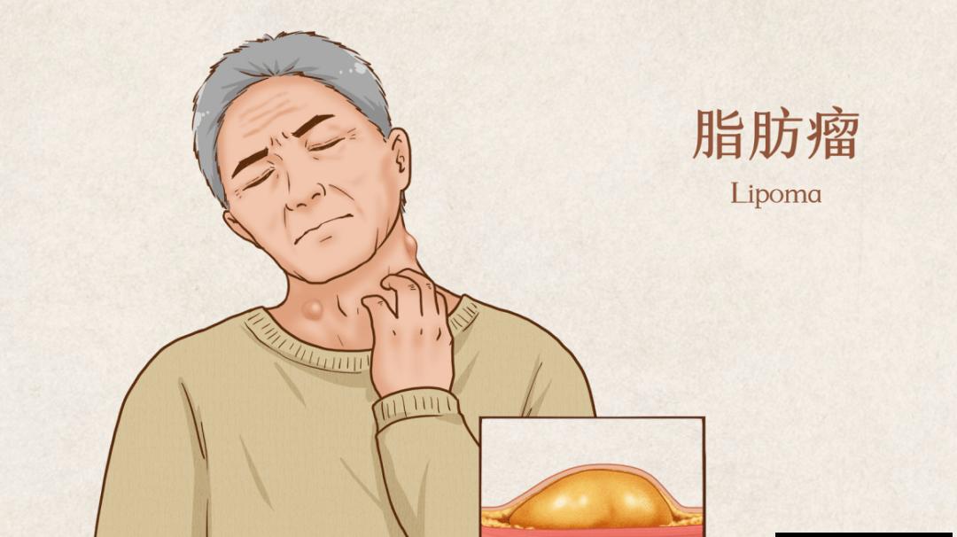 女子肚子变大以为是长胖一查是肿瘤.jpeg