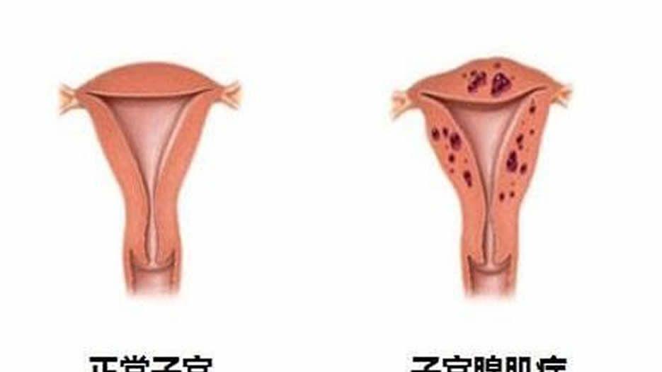 子宫腺肌症1.jpg