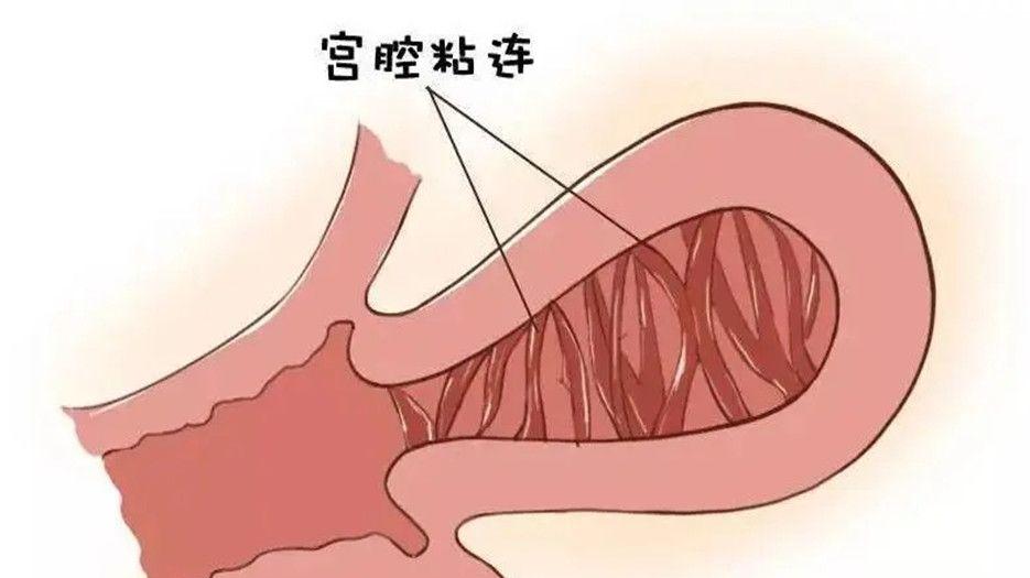 宫腔黏连.webp.jpg
