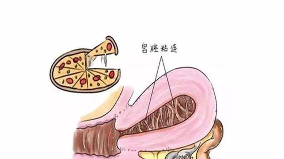 宫腔粘连.jpeg