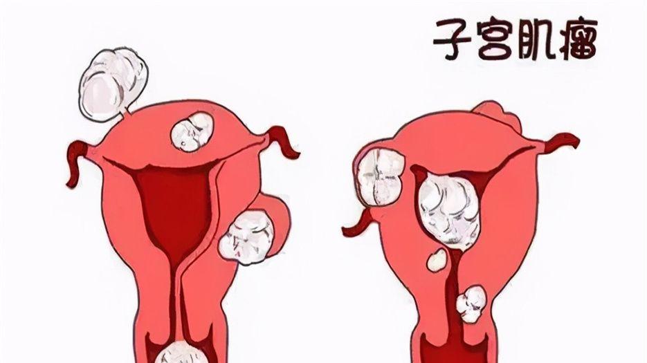 子宫肌瘤.jpg