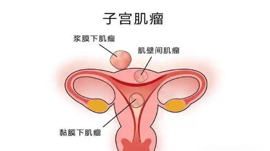 子宫肌瘤.jpg