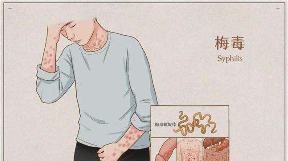 男性梅毒表现症状.jpeg