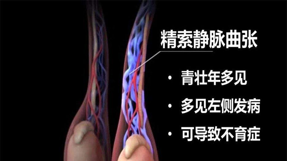 男性精索静脉曲张表现症状.jpeg