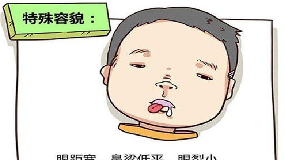 唐氏综合征 (2).jpg