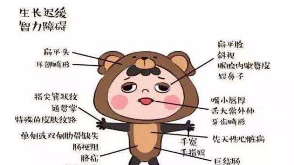 唐氏综合征 (2)_副本.jpg