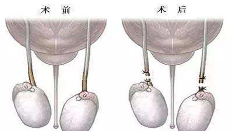 结扎 (2).jpg