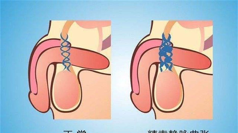精索静脉曲张 (1).jpg