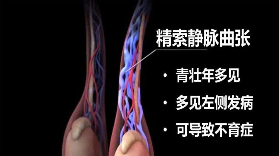 精索静脉曲张 (3).jpg