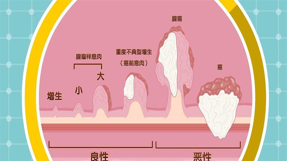 肠癌 (2).jpeg