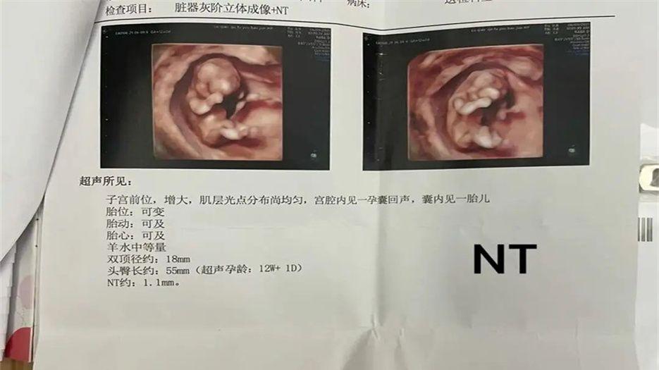 nt检查报告单.jpg