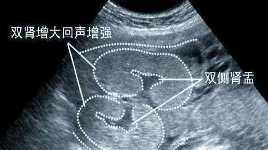 肾盂分离.jpeg