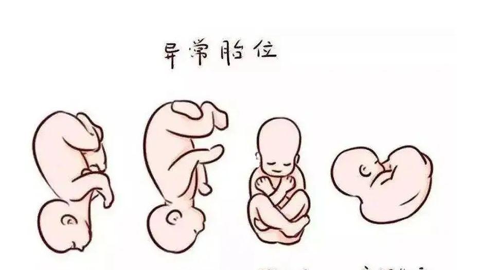 导致胎位不正
