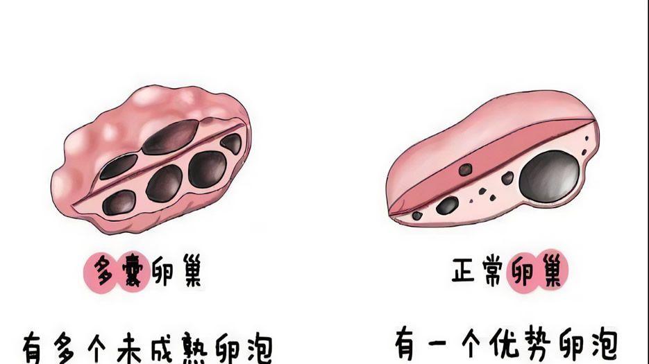 多囊卵巢综合征