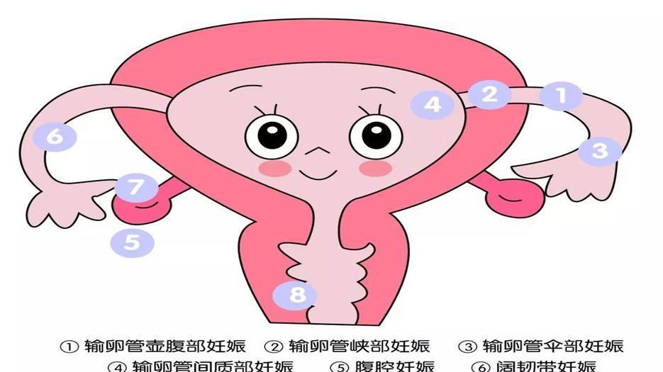 异位妊娠