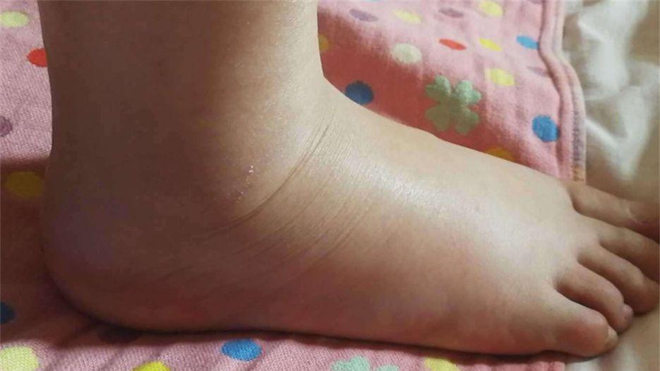 孕妇脚部水肿.jpeg