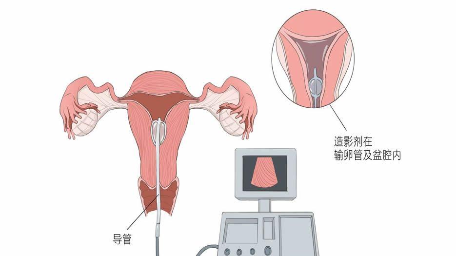 子宫输卵管造影检查