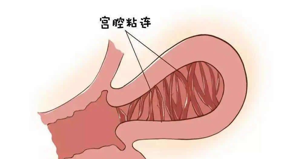 宫腔粘连