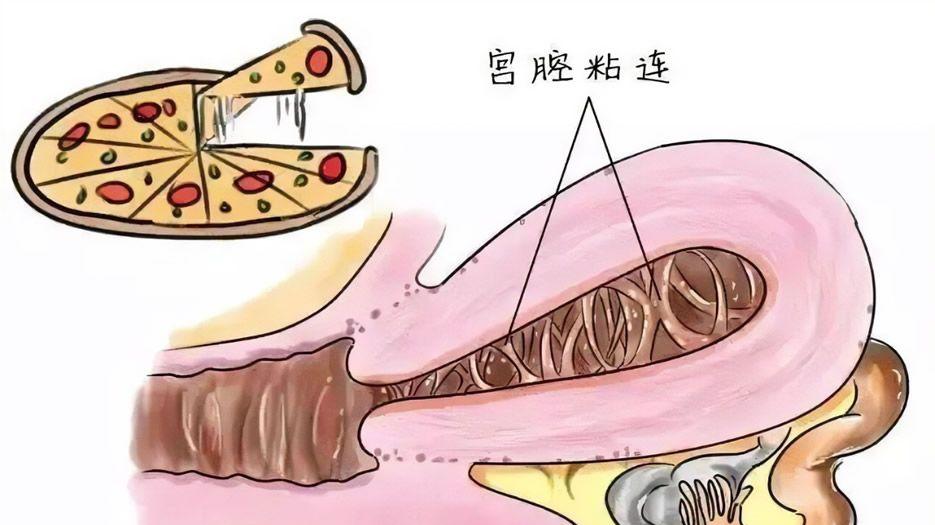 宫腔粘连