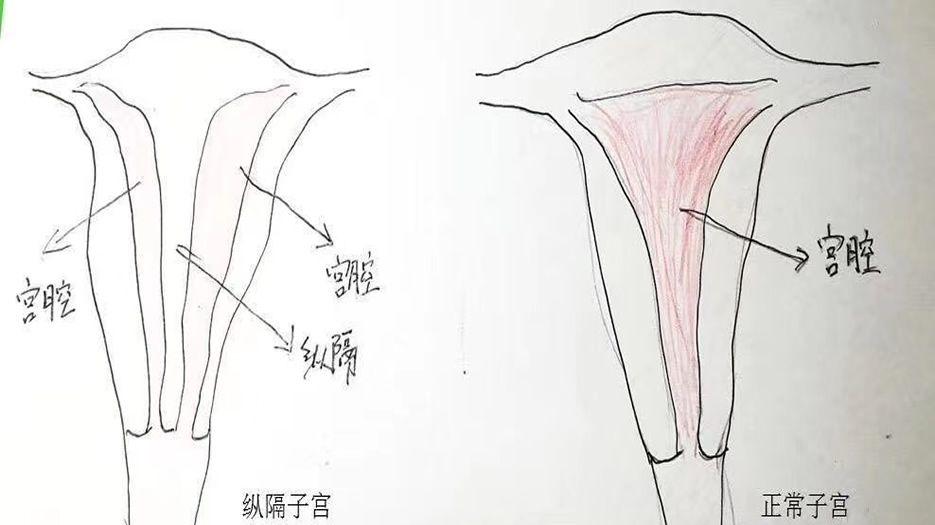 纵膈子宫