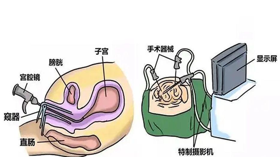 宫腔镜子宫纵膈切除术