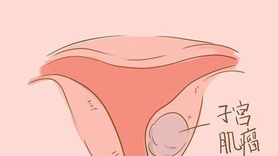 子宫肌瘤