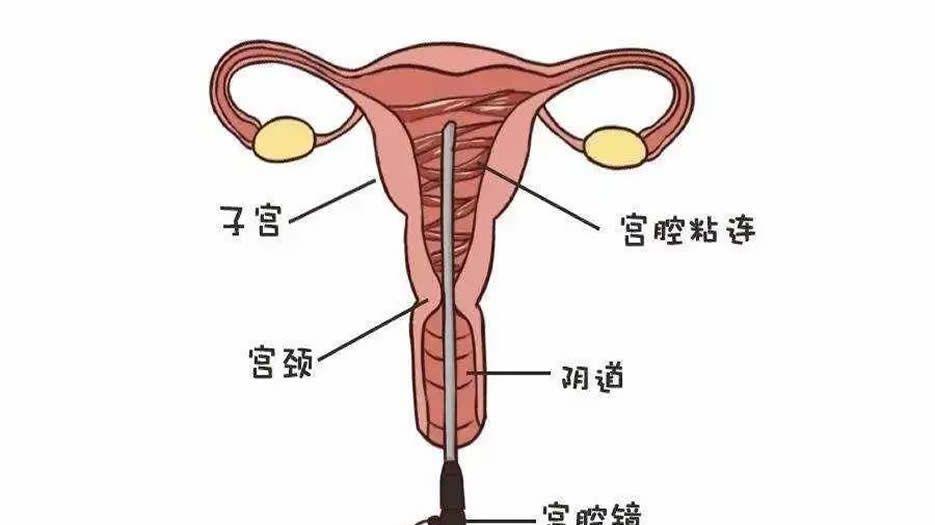  宫腔镜手术治疗